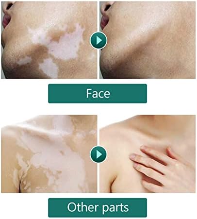         Corretivo de Vitiligo, tratamento de Vitiligo para reduzir manchas brancas, Vitiligo cobrindo líquido à prova d'água maquiagem Vitiligo corretivo cosméticos para rosto corpo 20ml       
